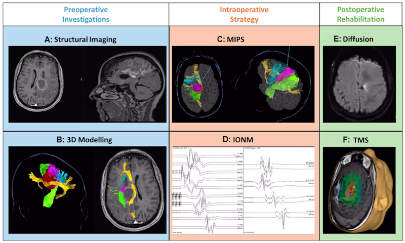 Cover image for 3D MultiModal MRI Segmentation