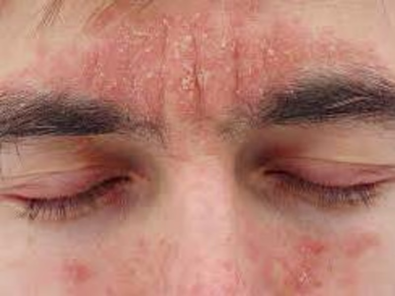 Cover image for Understanding Seborrheic Dermatitis – Octaskin