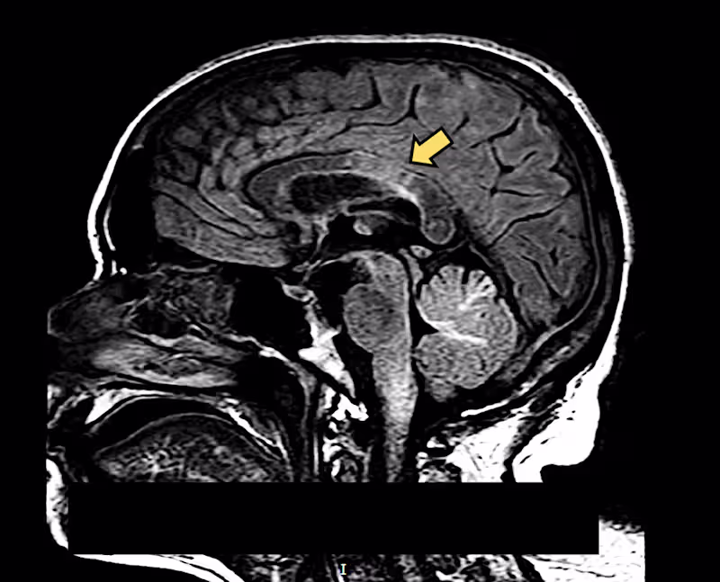 Cover image for Death following rapidly progressive demyelinating disorder in a…