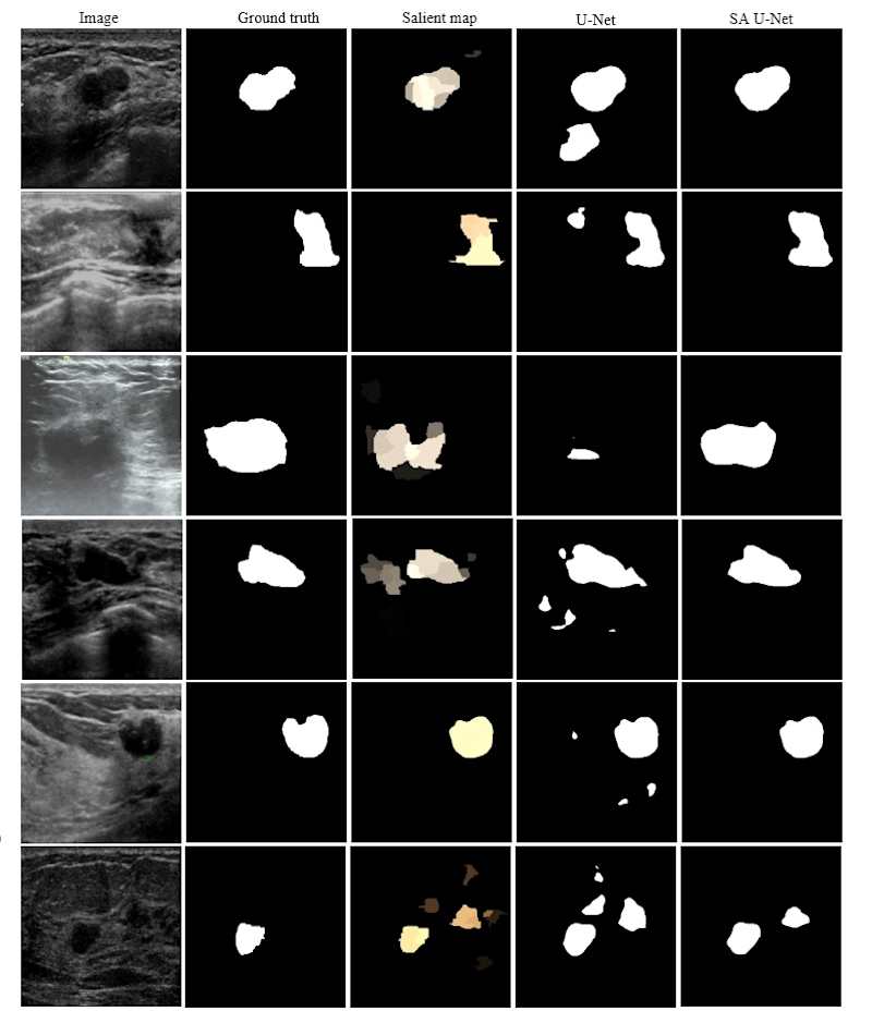 Cover image for Breast-Tumor-Segmentation-in-Ultrasound-Images