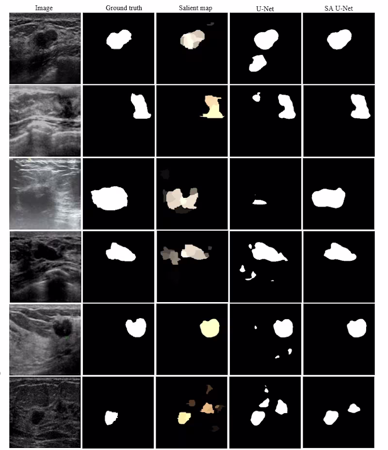 Cover image for Breast-Tumor-Segmentation-in-Ultrasound-Images