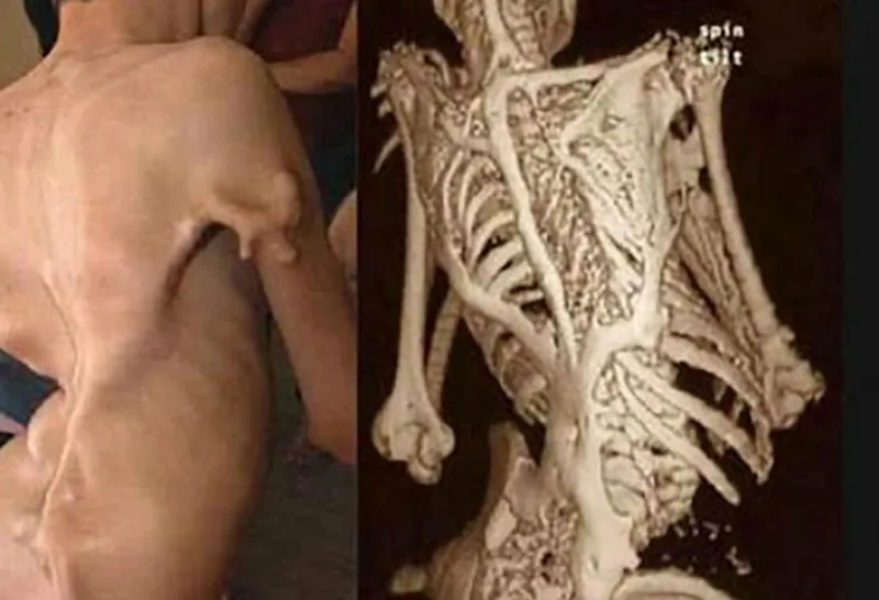 Cover image for Fibrodysplasia Ossificans Progressiva (Stoneman Syndrome)