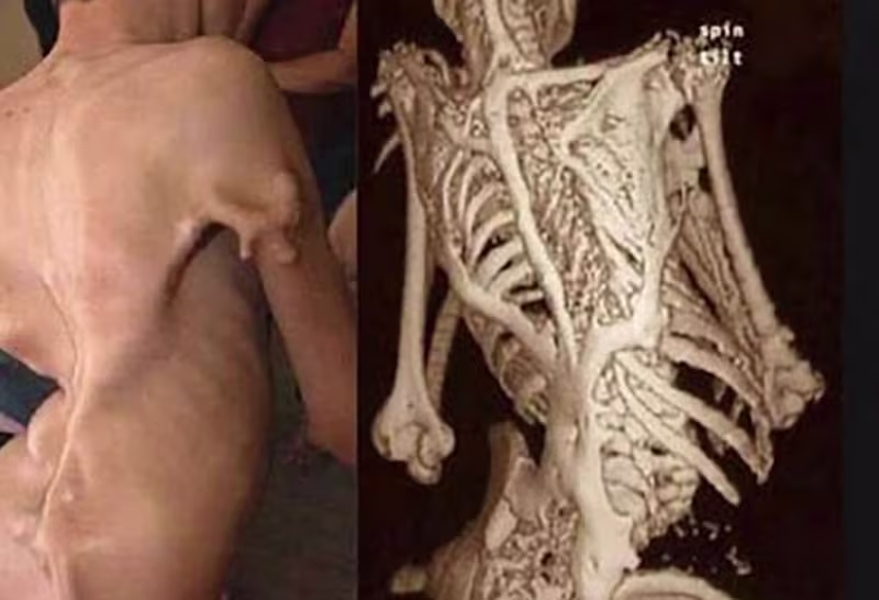 Cover image for Fibrodysplasia Ossificans Progressiva (Stoneman Syndrome)