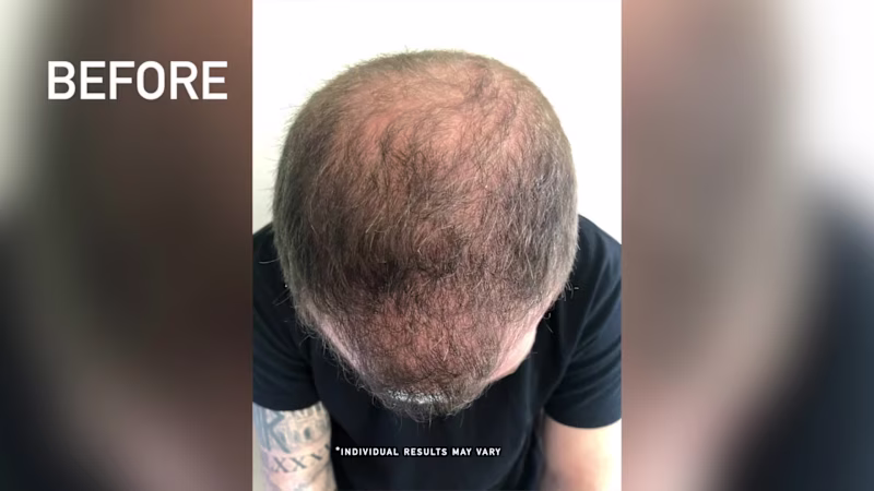 Cover image for iRestore Laser Hair Growth Device