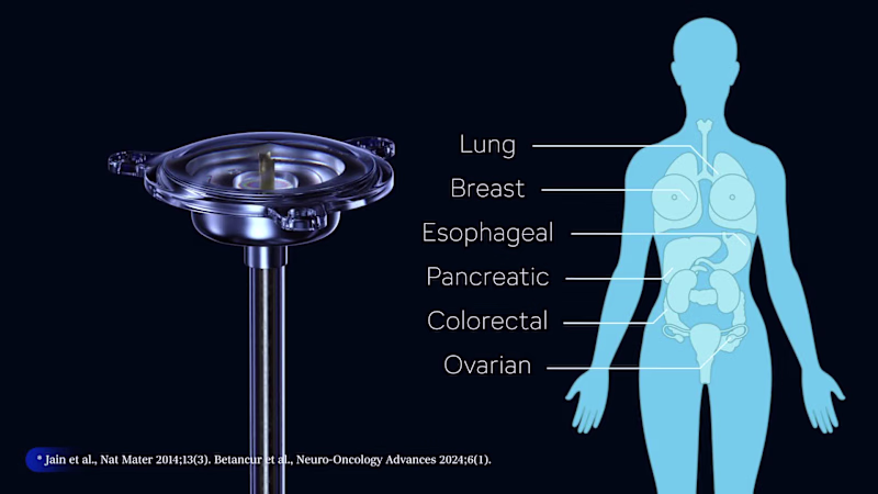 Cover image for Tumor Monorail - Exvade